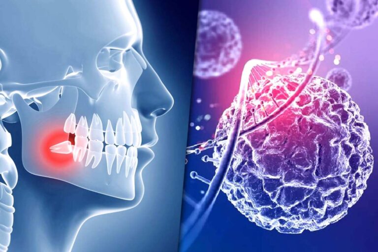 Muelas del juicio: la inesperada clave para curar enfermedades cerebrales