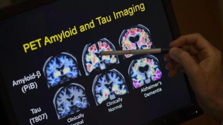 Casi el 80% de los pacientes con alzhéimer necesita servicios sociosanitarios, pero solo el 12% accede con financiación pública