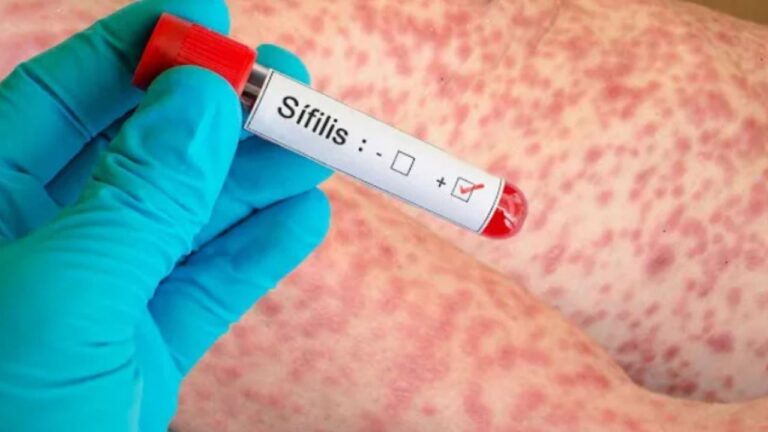 Alarma sanitaria por un récord de contagios de sífilis en Argentina